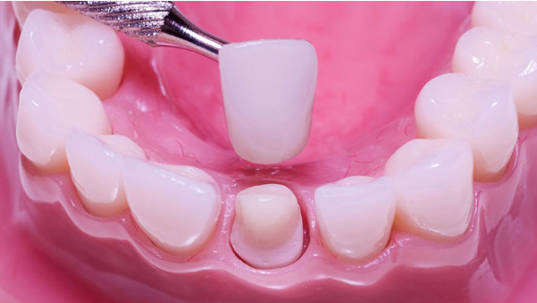 Bọc răng sứ thẩm mỹ
