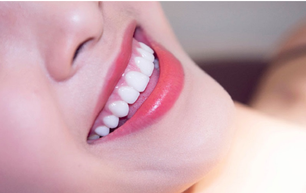 Bọc răng sứ Orodent Bleach