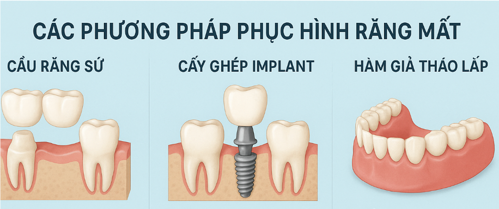 Phục Hình Răng Mất – Lấy Lại Nụ Cười Tự Tin Và Sức Khỏe Răng Miệng