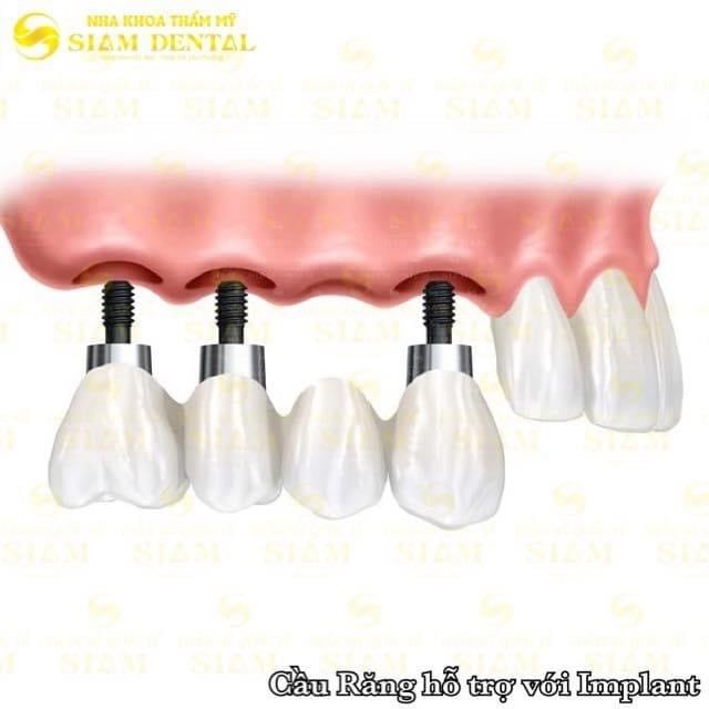 Top 3 phương pháp trồng răng giả được ưa chuộng