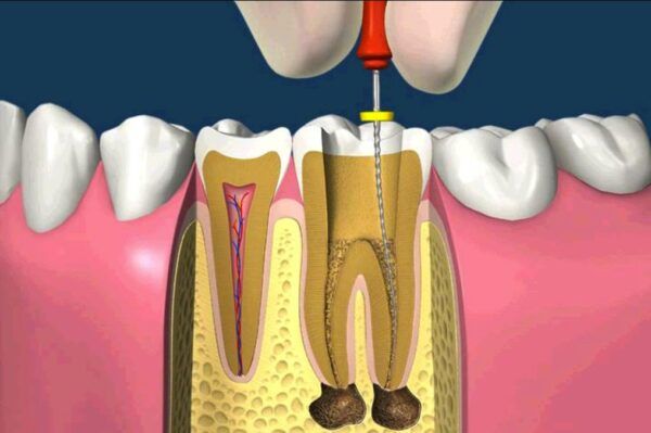 Tại Sao Phải Lấy Tủy Răng? Giải Đáp Từ Nha Khoa Siam Dental