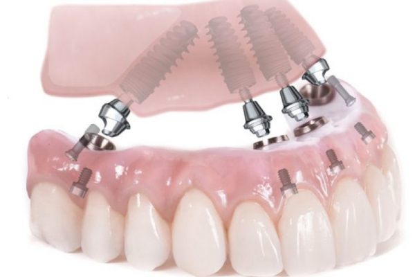 Răng Implant Toàn Hàm – Giải Pháp Tối Ưu Cho Mất Toàn Bộ Răng