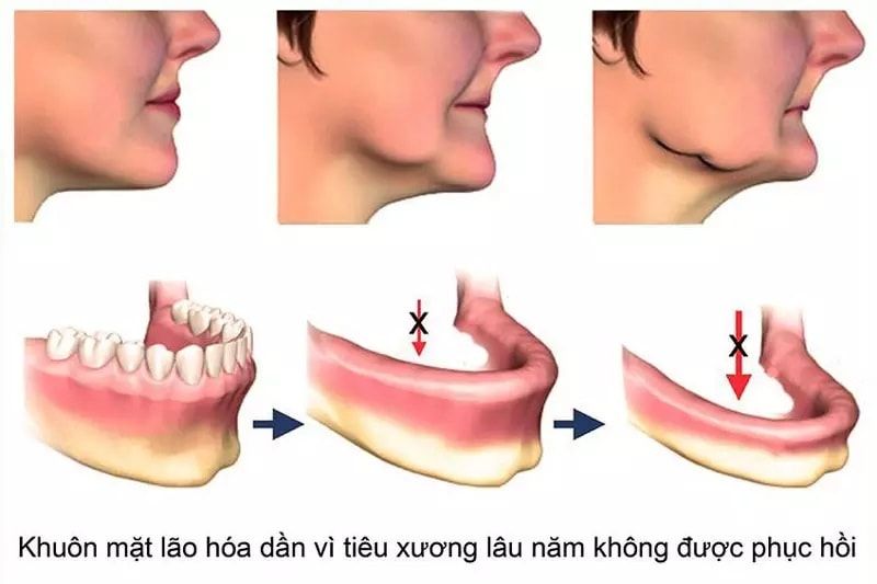 Bị Tiêu Xương Răng Trong Những Trường Hợp Nào?