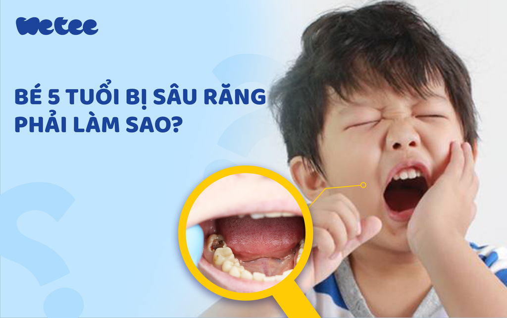 Bé 5 tuổi bị sâu răng hàm phải làm sao? Giải pháp chăm sóc và phòng ngừa từ Wetee