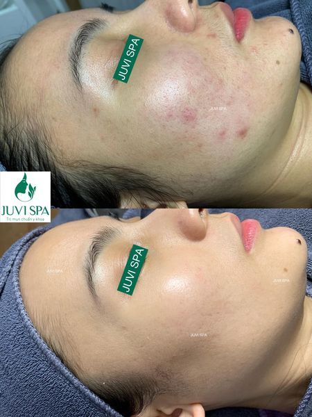 Mẫu content trị mụn – JUVI Spa
