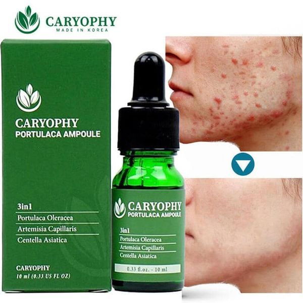 Mẫu content trị mụn – Serum trị mụn Caryophy
