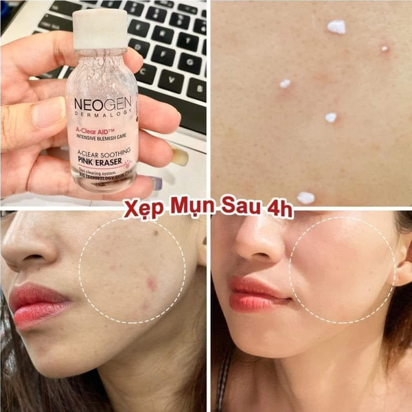 Mẫu content trị mụn - Chấm mụn Neogen