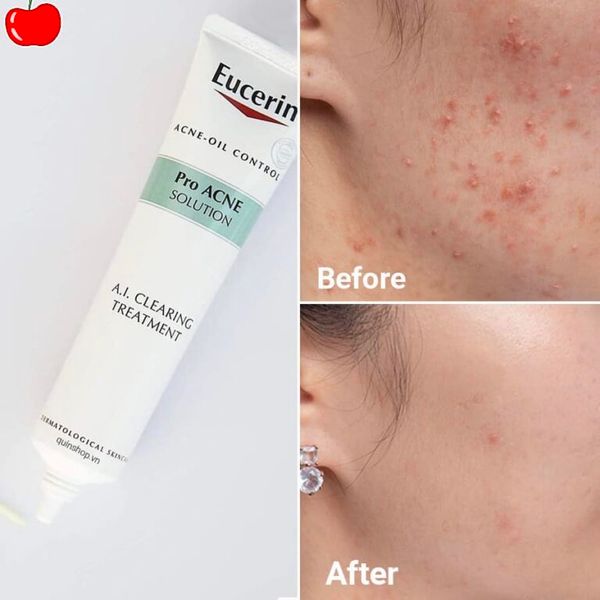 Mẫu content trị mụn - Kem trị mụn Eucerin Pro Acne Solution AI Clearing Treatment