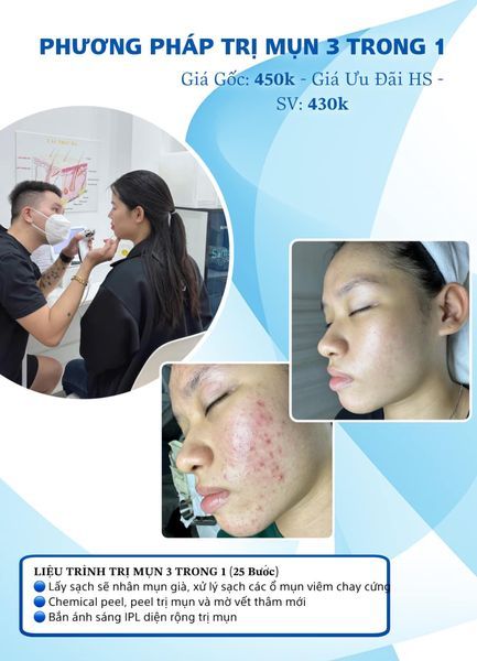 Mẫu content trị mụn – Peel da trị mụn