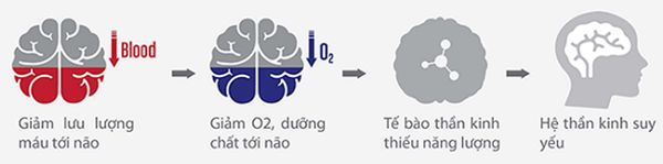 Thiếu máu não là gì?
