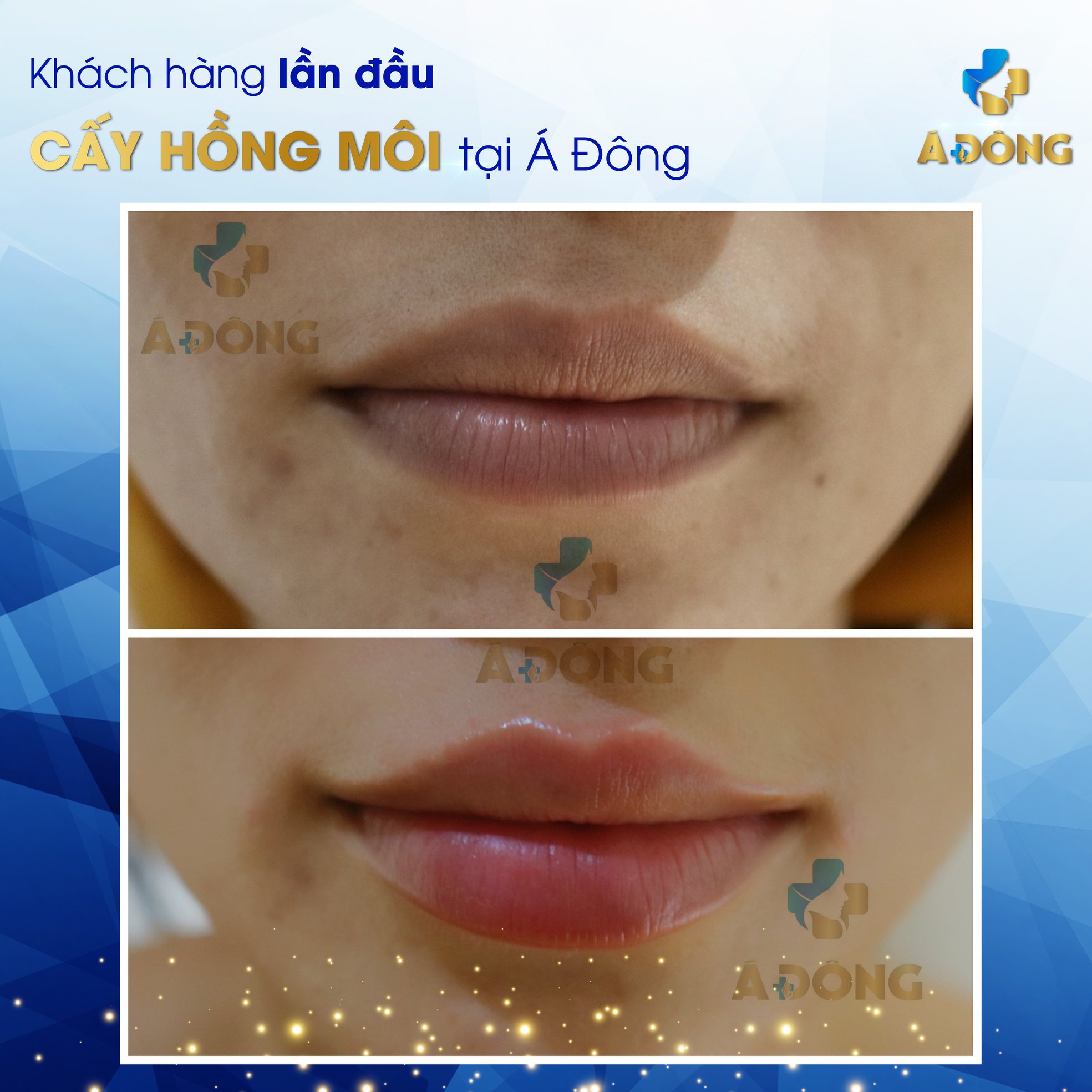 Cấy Hồng Môi