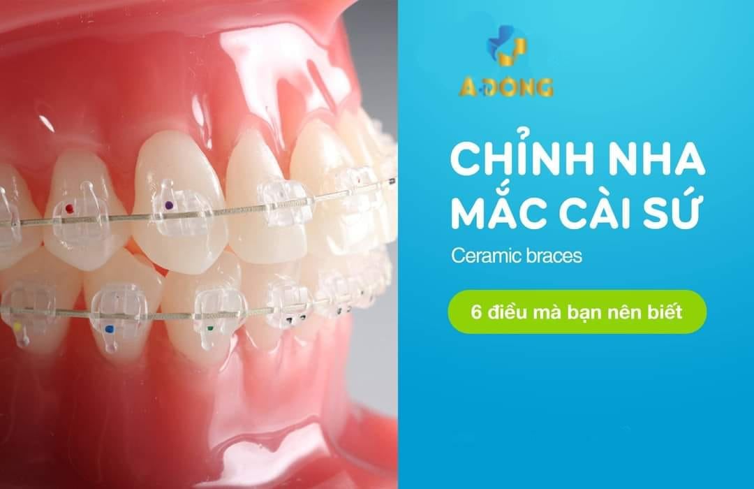 Niềng Răng Mắc Cài Sứ