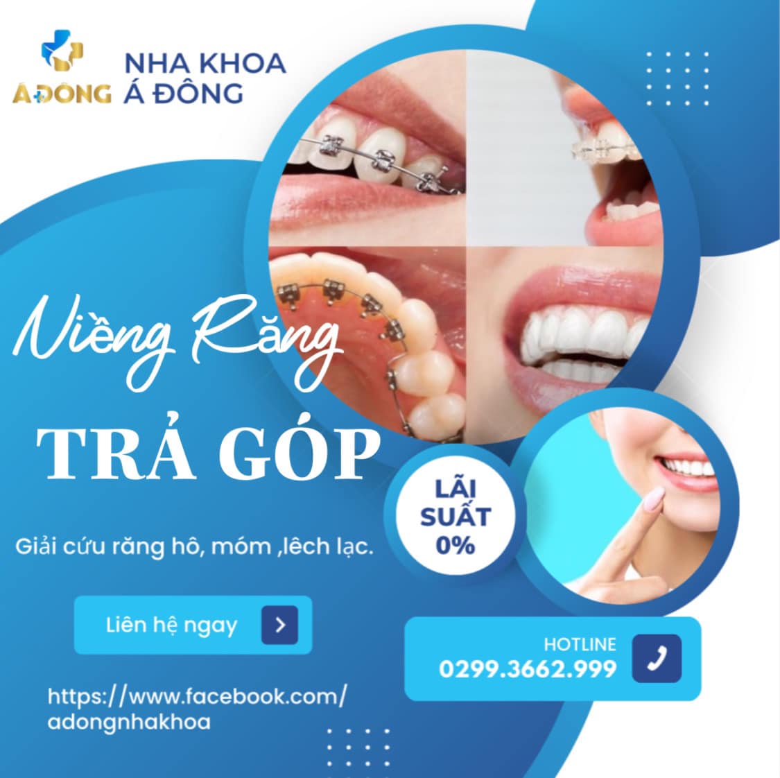 Trả góp 0% với dịch vụ niềng răng tại Nha khoa Á Đông