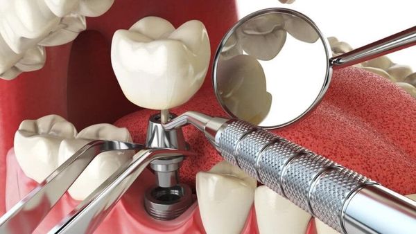Khuyến mãi trồng răng Implant hè 2023 - Nha khoa Á Đông