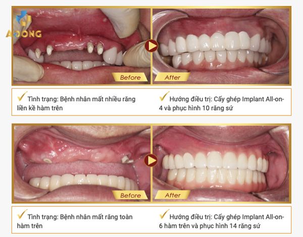 Khuyến mãi trồng răng Implant hè 2023 - Nha khoa Á Đông