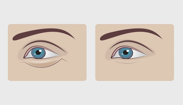 Bọng mắt là gì - Nhận biết bọng mắt