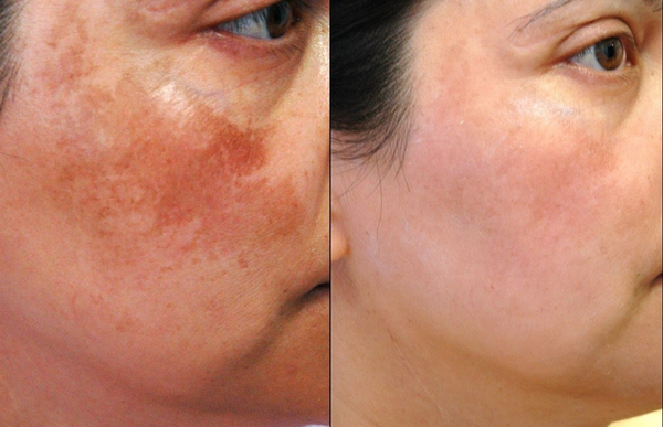 Có nên peel da không