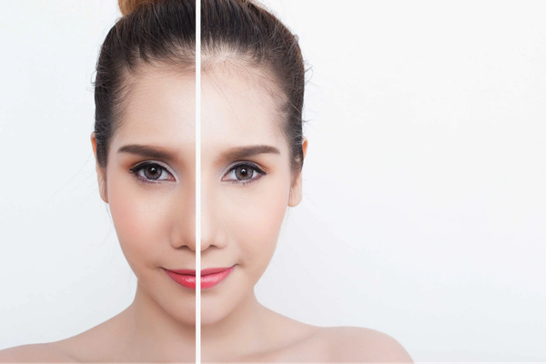 Có nên peel da không