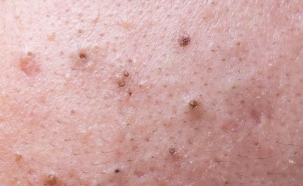 nặn mụn đầu đen