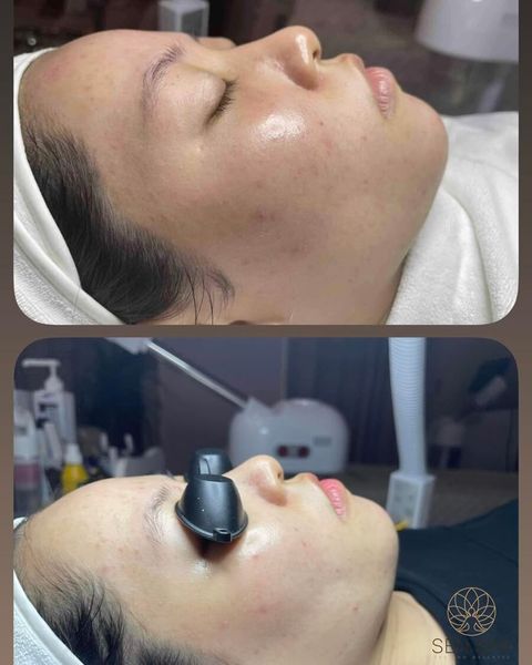 Meso trị mụn tại Long Biên