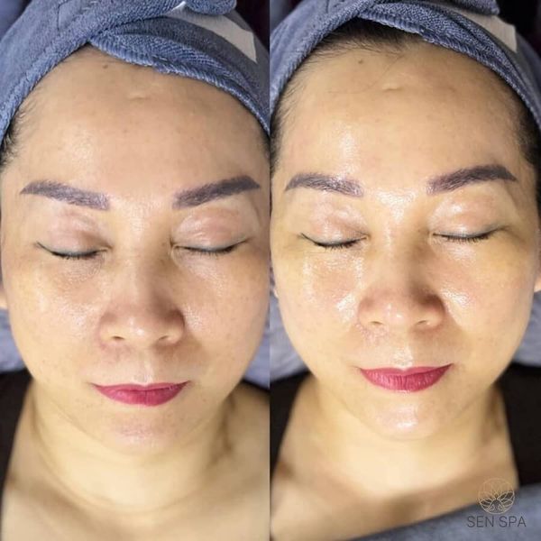 cách chăm sóc da mặt bị nám