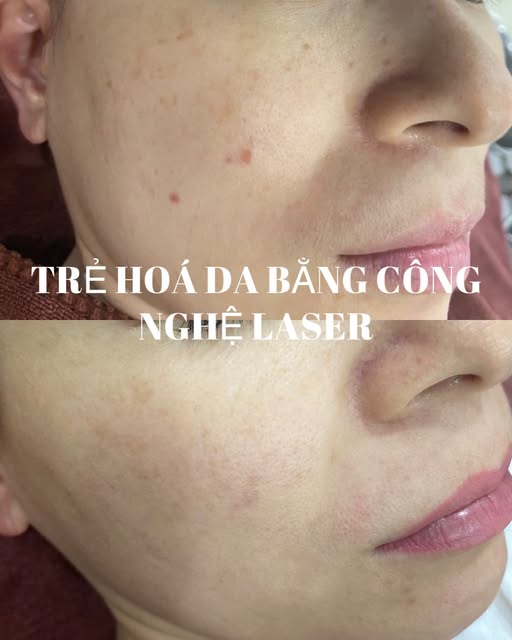 Content chăm sóc da - Huyền Spa