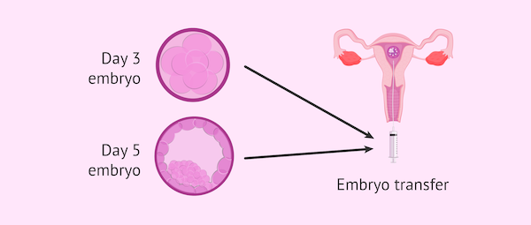 Day 5 vs. Day 3 Embryo Transfer – What Are the Pros & Cons? ivfholymothers
