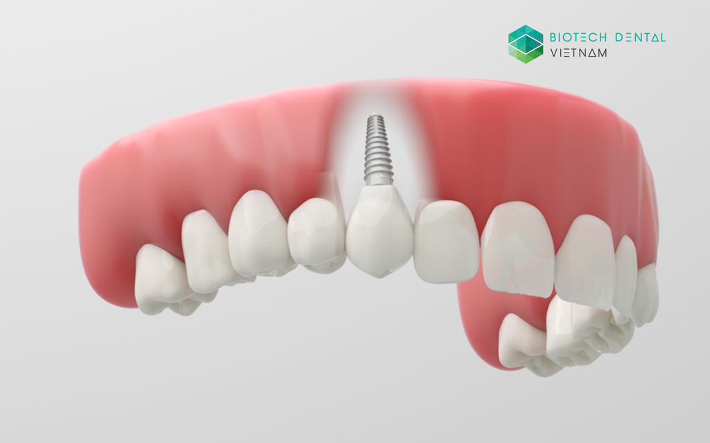 Công nghệ cấy ghép implant tức thì và ứng dụng trong điều trị nha khoa