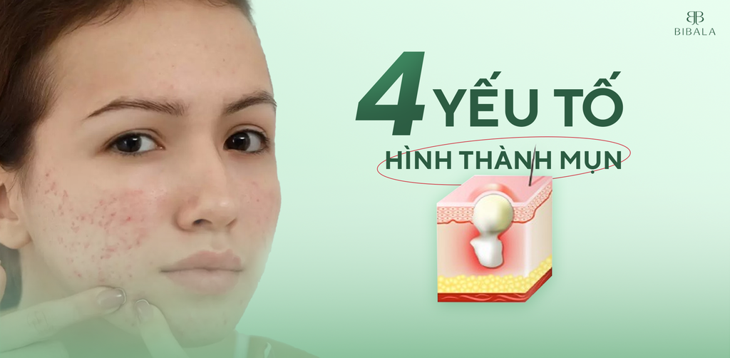 MỤN, NGUYÊN NHÂN VÀ 4 YẾU TỐ HÌNH THÀNH