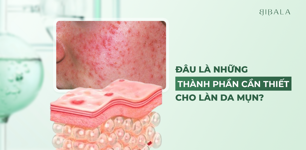 Đâu là những thành phần cần thiết cho làn da mụn?