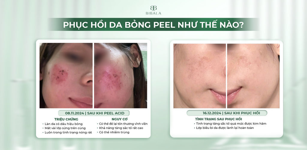 BIBALA ĐÃ PHỤC HỒI MỘT LÀN DA BỎNG PEEL NHƯ THẾ NÀO?