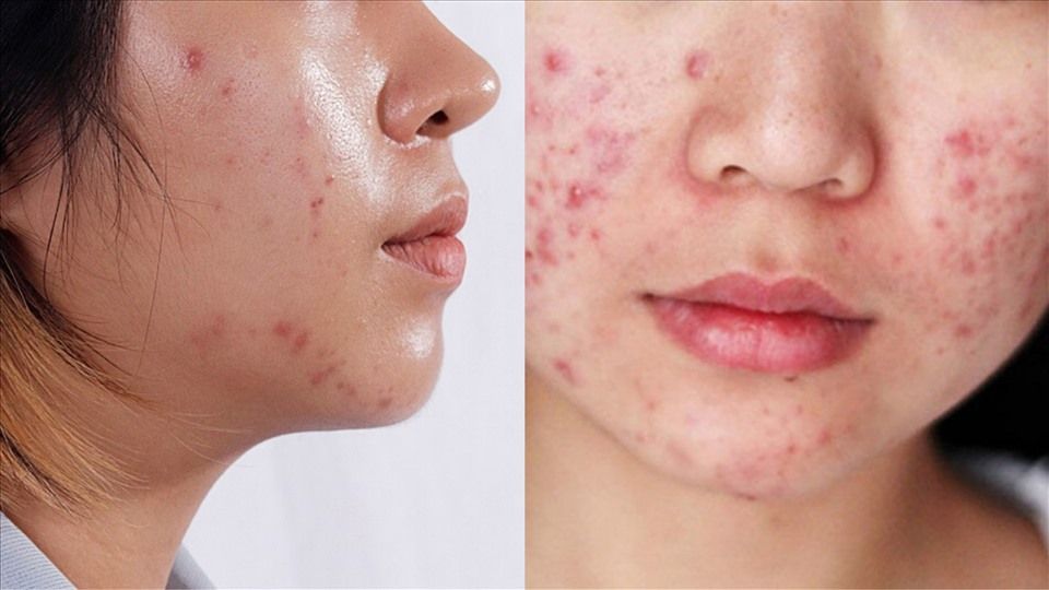 CHỌN NƯỚC DƯỠNG LÀM SÁNG MỊN CHO DA DẦU MỤN NHẠY CẢM