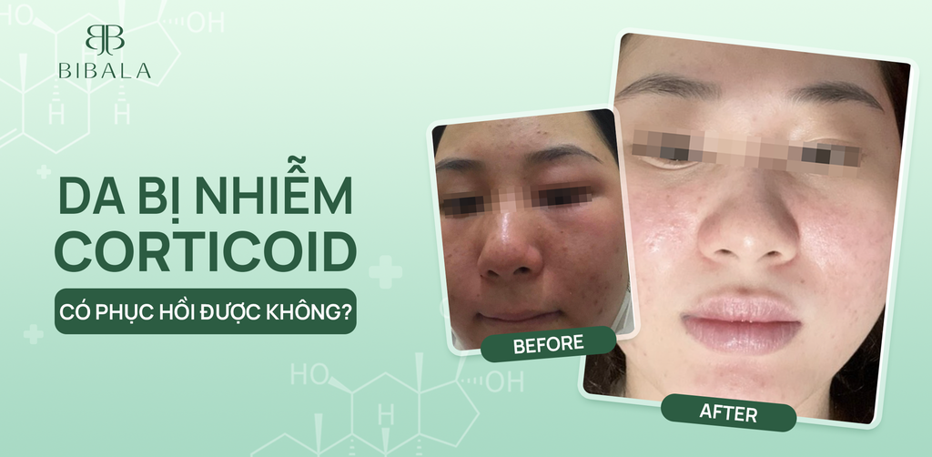 DA BỊ NHIỄM CORTICOID CÓ PHỤC HỒI ĐƯỢC KHÔNG?