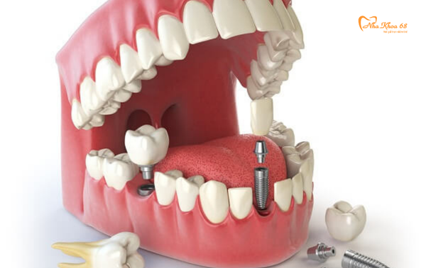 Quy trình cấy ghép răng Implant đúng tiêu chuẩn !