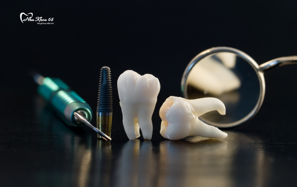 Quy trình chuẩn trồng răng implant an toàn, thẩm mỹ