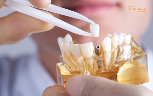 Trồng răng Implant sử dụng trong bao lâu ?