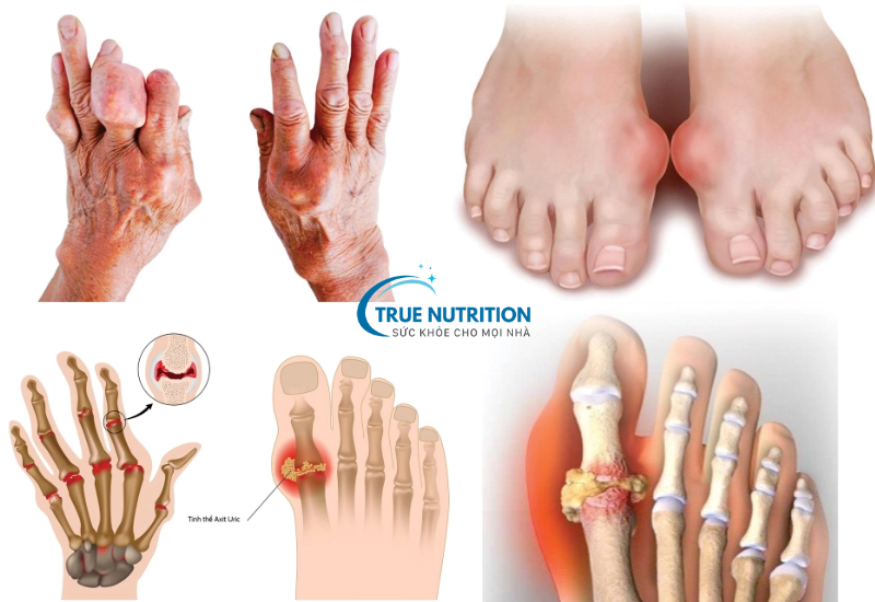 Bệnh gout - nguyên nhân, triệu chứng, cách điều trị và phòng ngừa