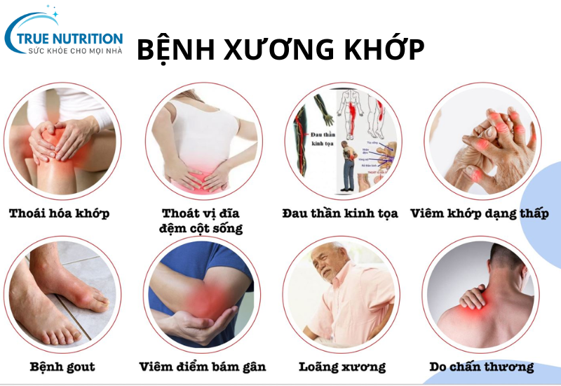Bệnh xương khớp trở nặng - những lưu ý và cách phòng ngừa