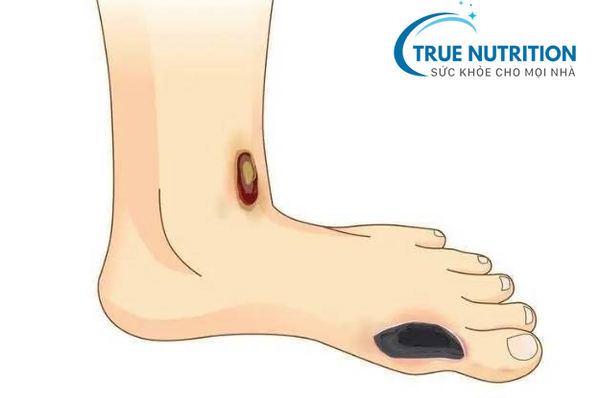 Biến Chứng Mạn Tính của Bệnh Tiểu Đường