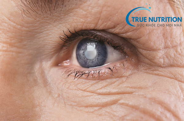 Biến chứng đục thủy tinh thể ở người tiểu đường