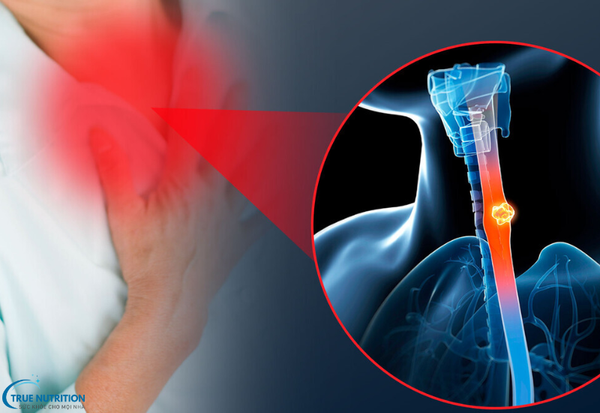 Triệu Chứng Bệnh Viêm Thực Quản: Đừng Bỏ Qua Những Cảnh Báo Sớm Này!