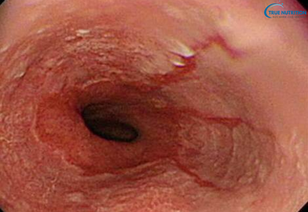 Triệu Chứng Bệnh Viêm Thực Quản: Đừng Bỏ Qua Những Cảnh Báo Sớm Này!