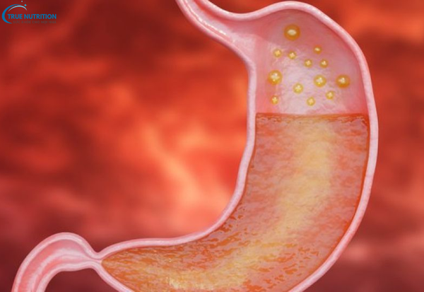 Triệu Chứng Bệnh Viêm Thực Quản: Đừng Bỏ Qua Những Cảnh Báo Sớm Này!