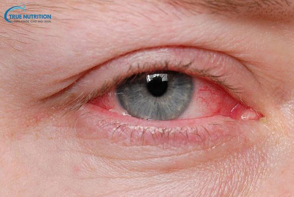 5 Mẹo Chữa Ngứa Khóe Mắt. Ngứa Khóe Mắt Liệu Có Nguy Hiểm Không?