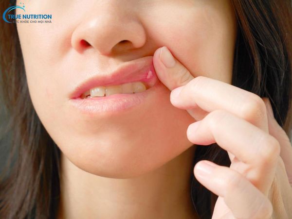 Nổi Mụn Trắng Trong Miệng Không: Đau Nguyên Nhân & Cách Xử Lý