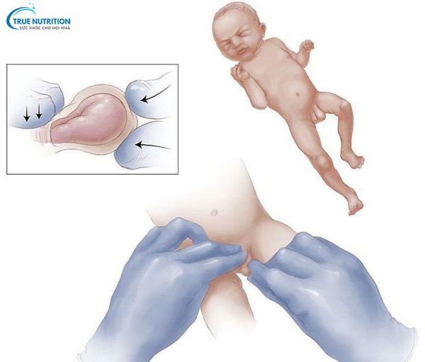 Hình Ảnh Thoát Vị Bẹn Ở Bé Trai: Nhận Biết, Phân Biệt Và Điều Trị