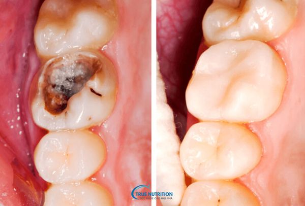 Tác Hại Của Việc Trám Răng, Chi Phí, Tuổi Thọ, Chăm Sóc