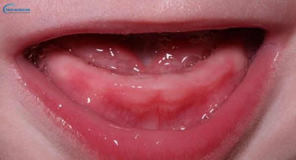 Nhận Diện Hình Ảnh Lợi Trẻ Sắp Mọc Răng: Dấu Hiệu, Chăm Sóc