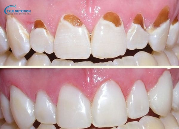 Tác Hại Của Việc Trám Răng, Chi Phí, Tuổi Thọ, Chăm Sóc