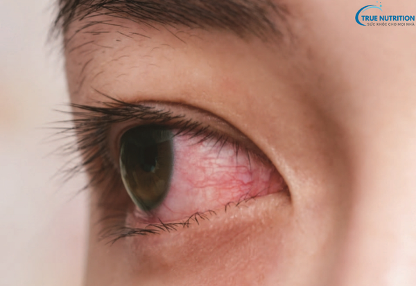 Bệnh glôcôm là gì? Những điều cần biết để bảo vệ thị lực của bạn